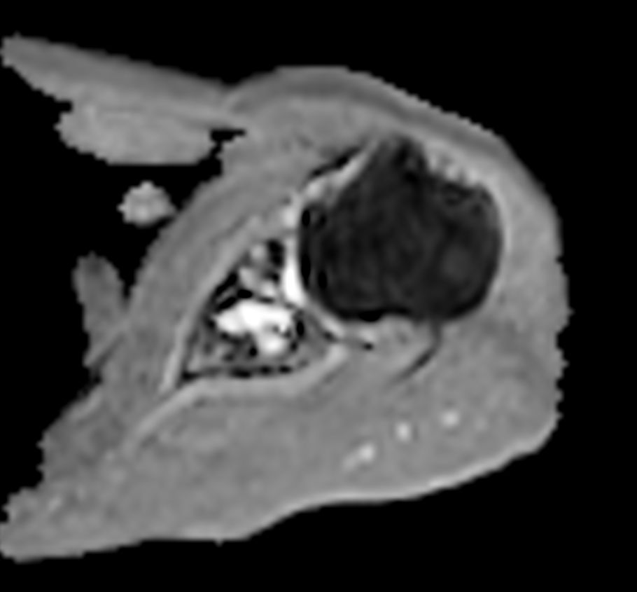 Axial DWI EPI (ADC) - High resolution