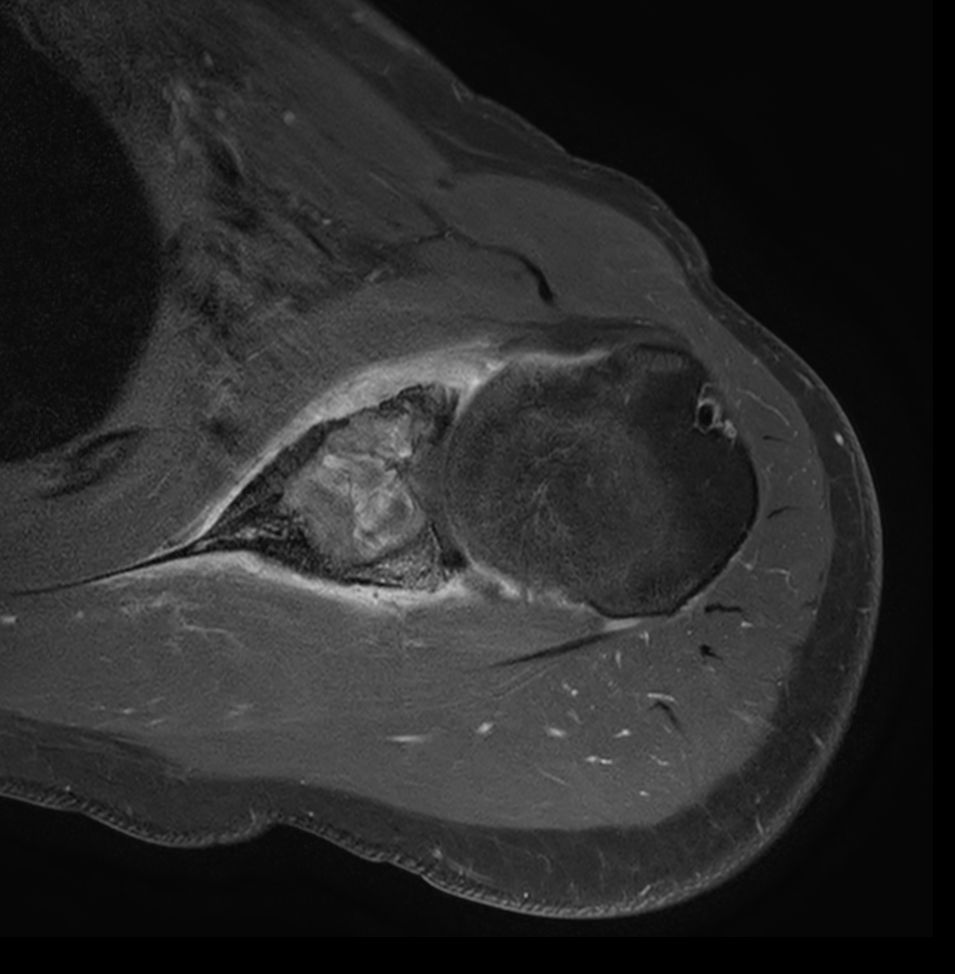 Axial T1w SPIR - Post gado
