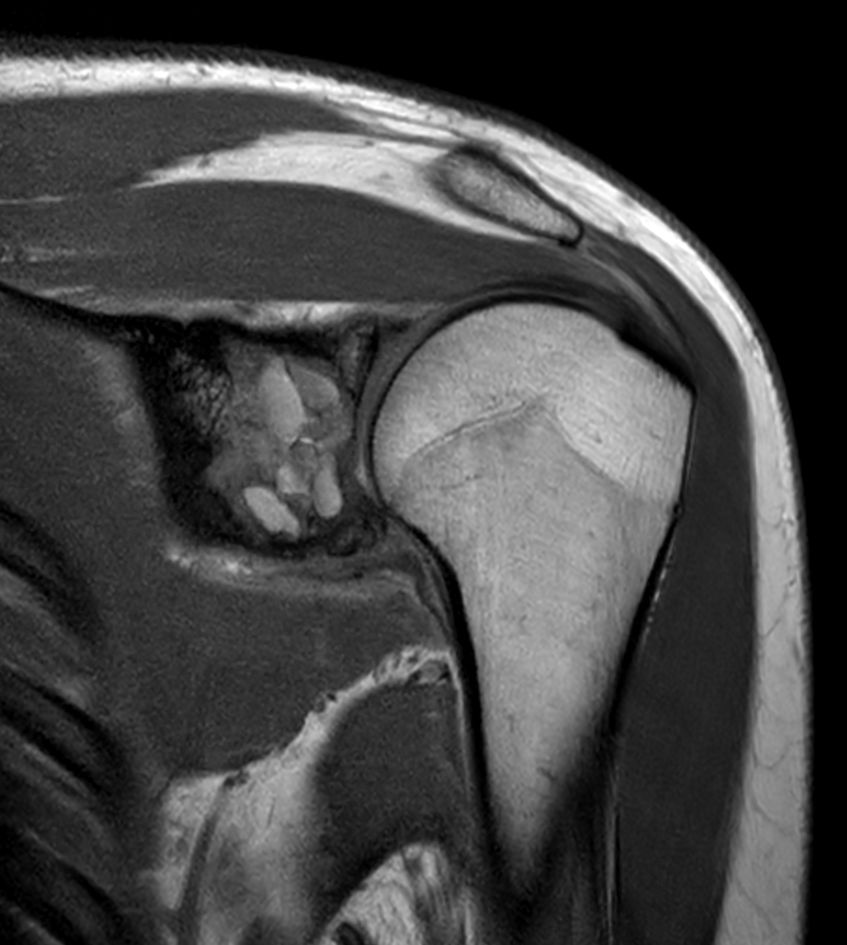 Coronal T1w mDIXON XD TSE - Compressed SENSE (In Phase)