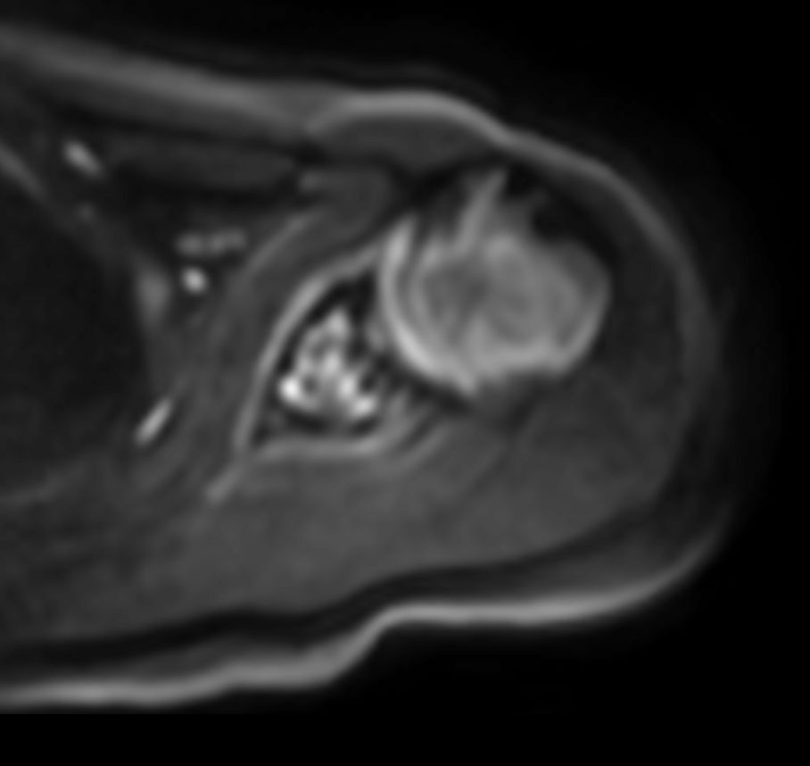 Axial DWI EPI (b1000)