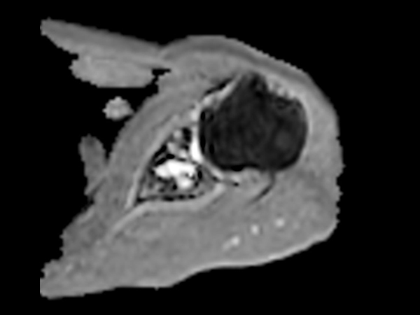 Axial DWI EPI (ADC) - High resolution