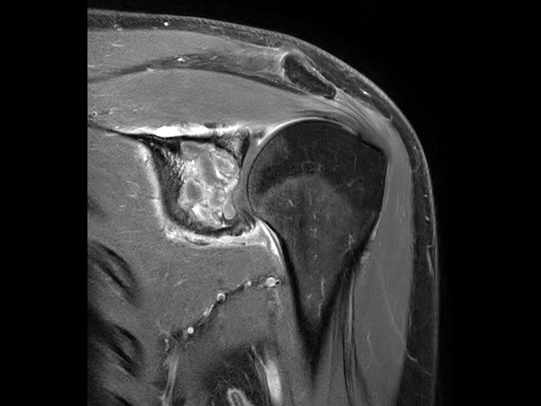 Coronal T1w mDIXON XD TSE - Compressed SENSE (Water only) - Post-gado