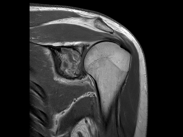 Coronal T1w mDIXON XD TSE - Compressed SENSE (In Phase) - Post gado