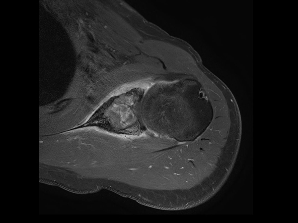 Axial T1w SPIR - Post gado