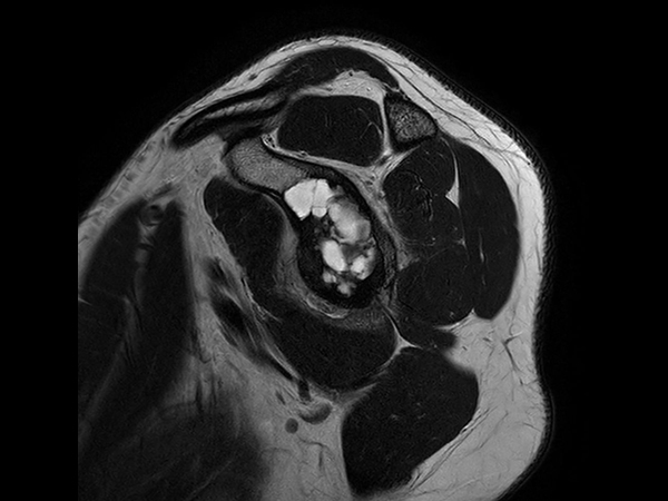 Sagittal T2w TSE - Compressed SENSE