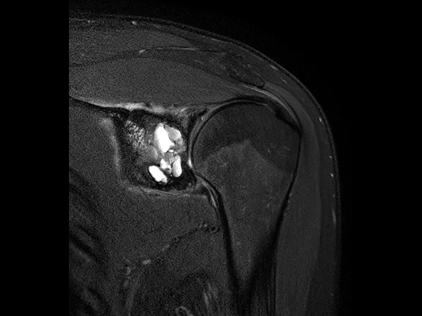 Coronal T2w SPAIR - Compressed SENSE