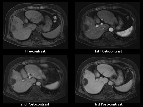 Axial dynamic mDIXON (Water Only)