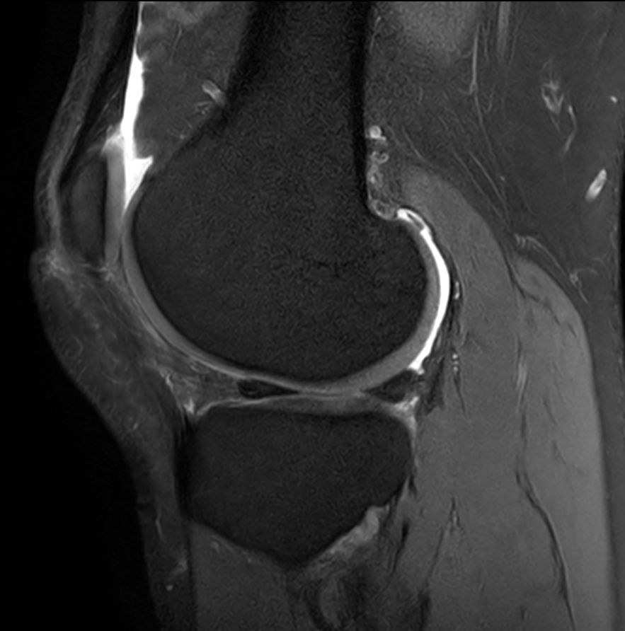 Sagittal PDw SPAIR - Compressed SENSE