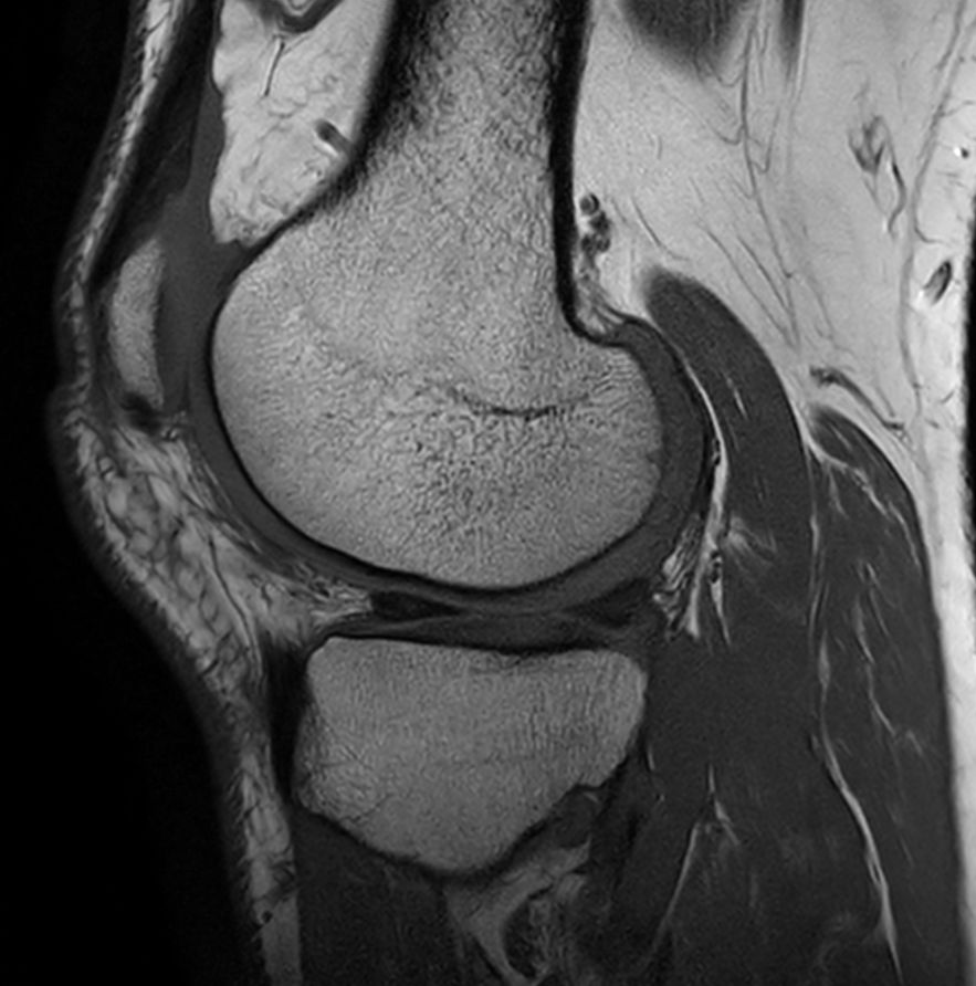 Sagittal T1w TSE - Compressed SENSE