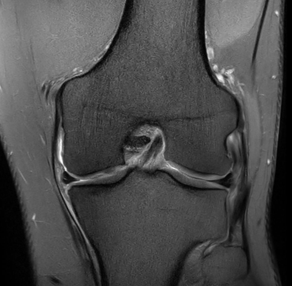 Coronal PDw SPIR - Compressed SENSE