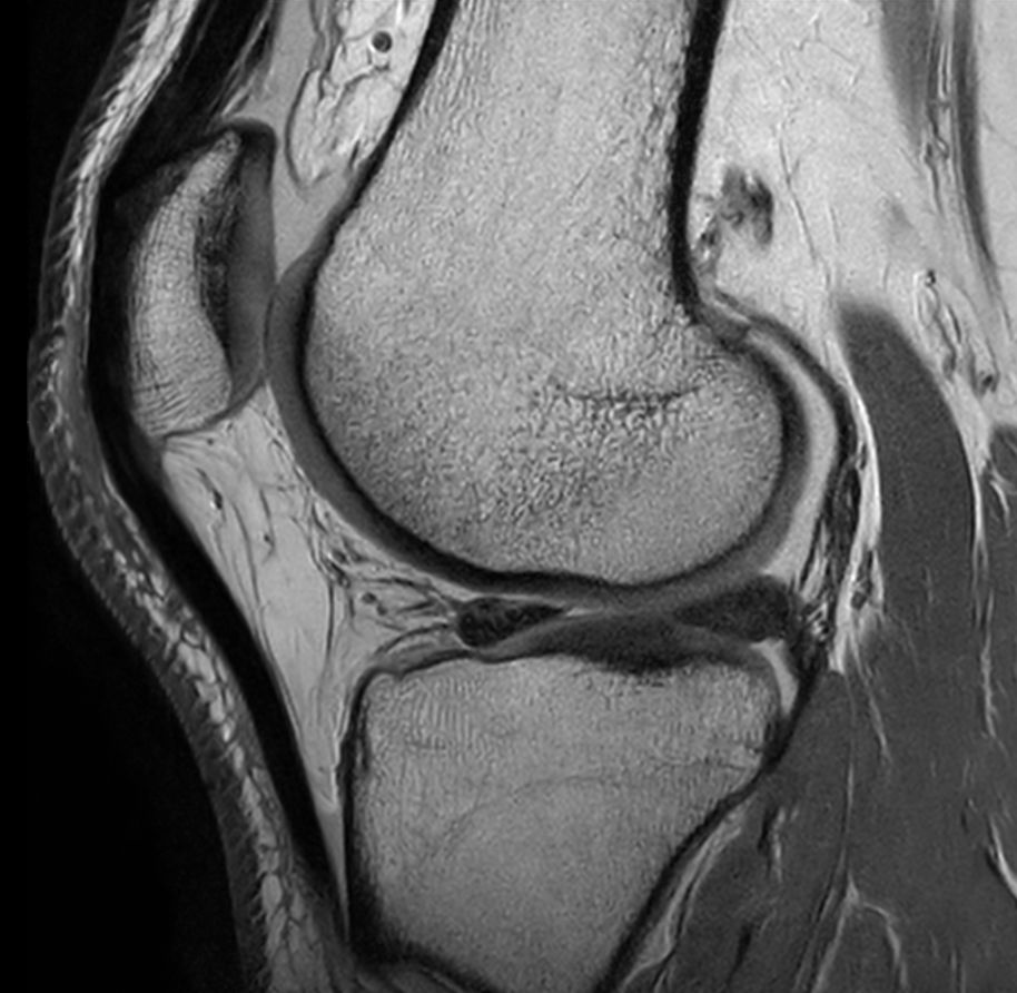 Sagittal PDw TSE - Compressed SENSE (High resolution)