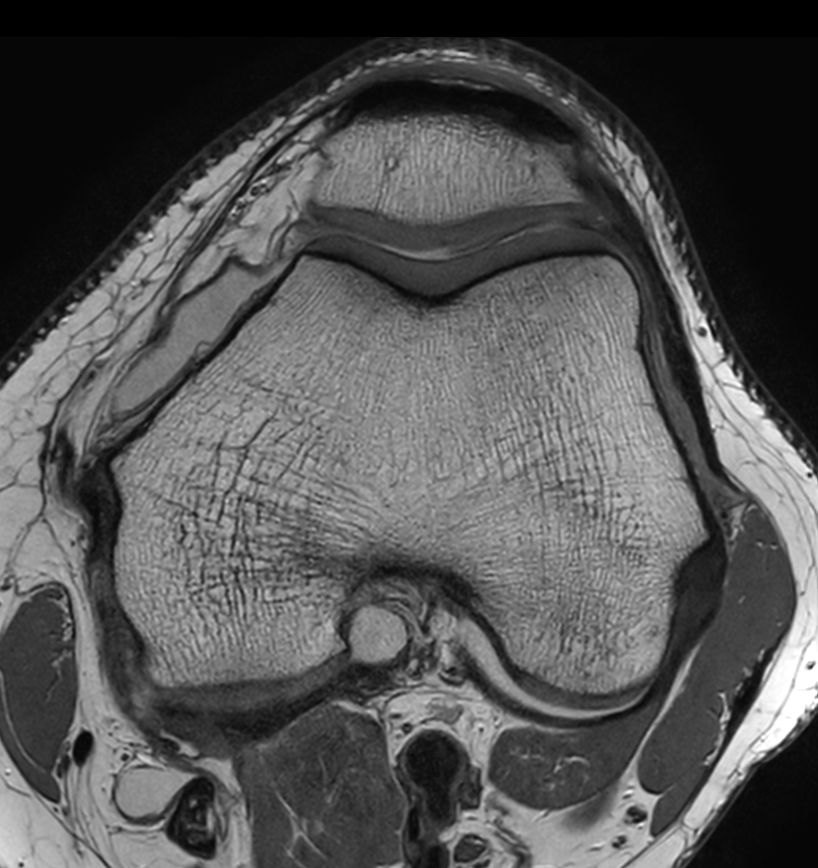 Axial PDw TSE - Compressed SENSE (High resolution)