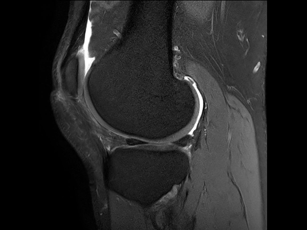 Sagittal PDw SPAIR - Compressed SENSE