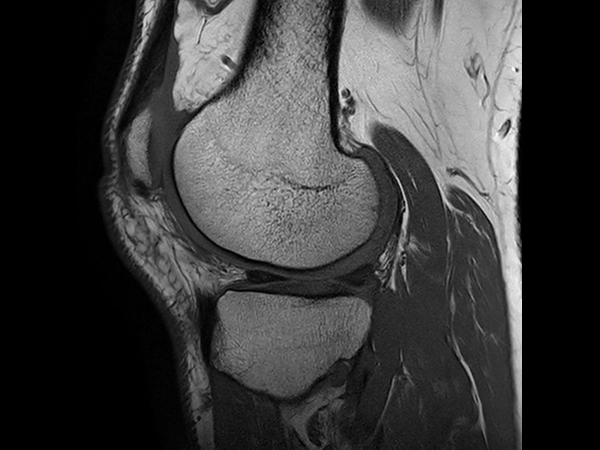 Sagittal T1w TSE - Compressed SENSE