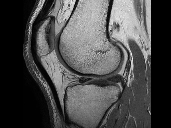 Sagittal PDw TSE - Compressed SENSE (High resolution)