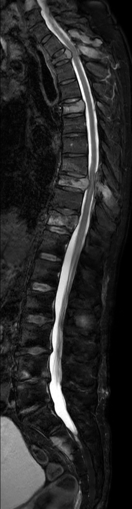 Sagittal T2w mDIXON XD TSE (Water only)