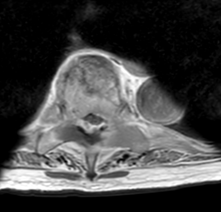 Axial T1w mDIXON XD TSE (In Phase) +gado (T8)