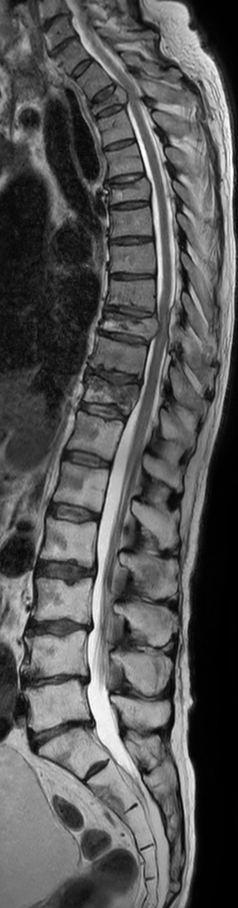 Sagittal T2w mDIXON XD TSE (In Phase)