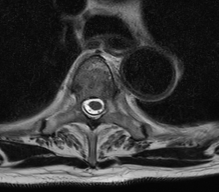 Axial T2w TSE - High res (T4)