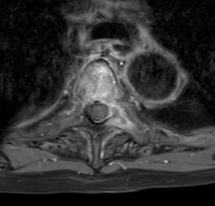 Axial T1w mDIXON XD TSE (Water only) +gado (T4)