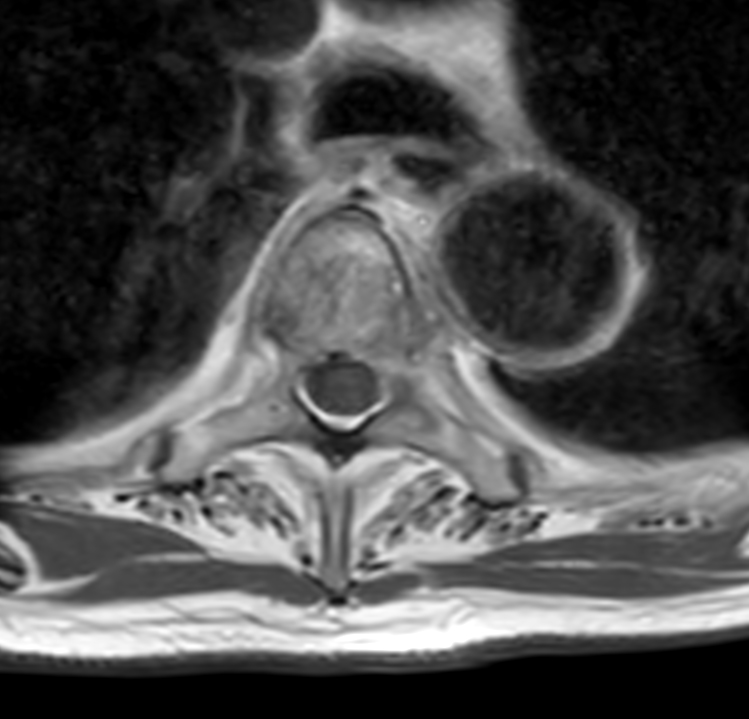 Axial T1w mDIXON XD TSE (In Phase) +gado (T4)
