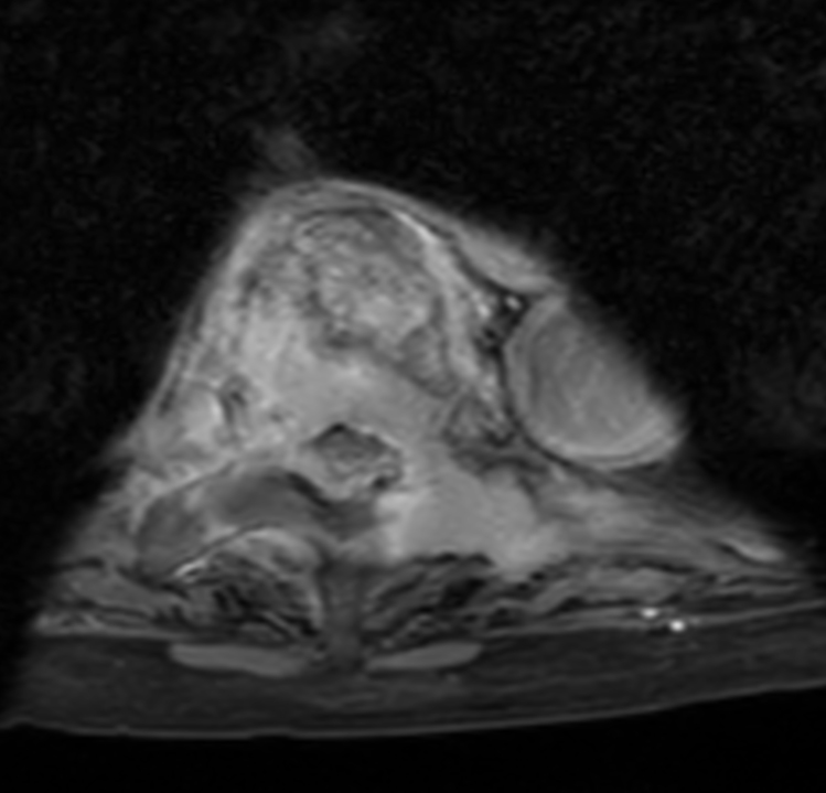 Axial T1w mDIXON XD TSE (Water only) +gado (T8)