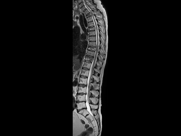 Sagittal T2w mDIXON XD TSE (In Phase)