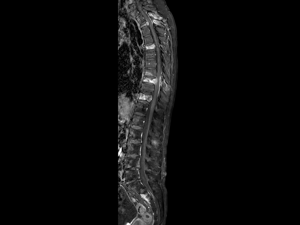 Sagittal T1w mDIXON XD TSE (Water only) +gado