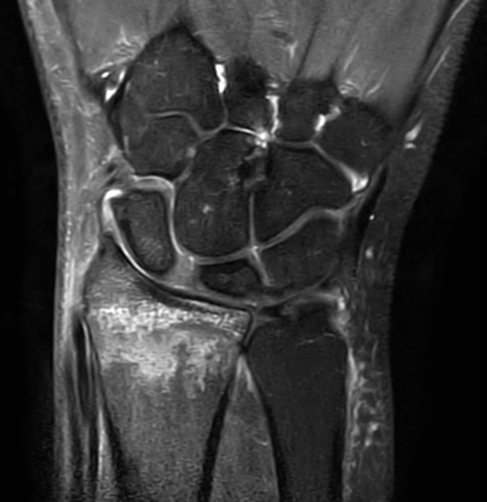 2D Coronal PDw SPAIR