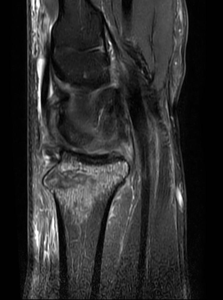 2D Sagittal PDw SPAIR