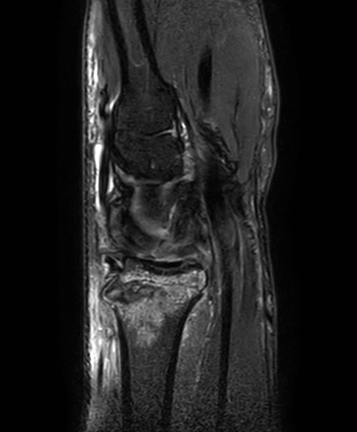 3D Sagittal PDw SPAIR