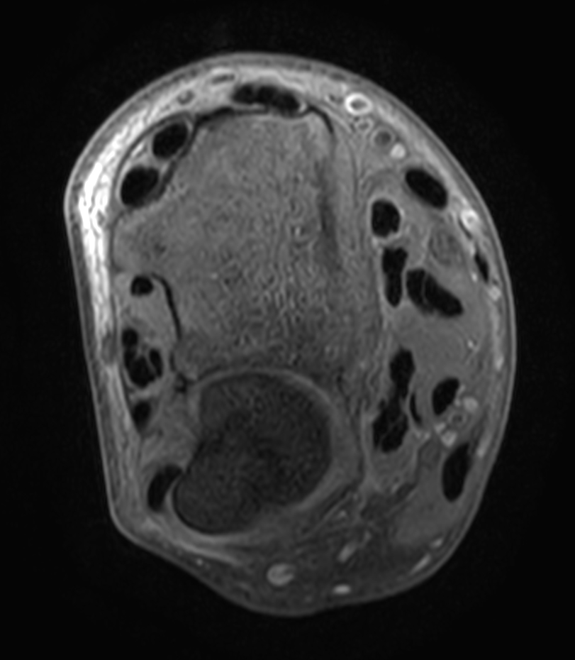 2D Axial T1w SPIR +gado