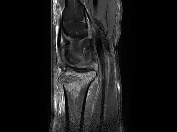 2D Sagittal PDw SPAIR