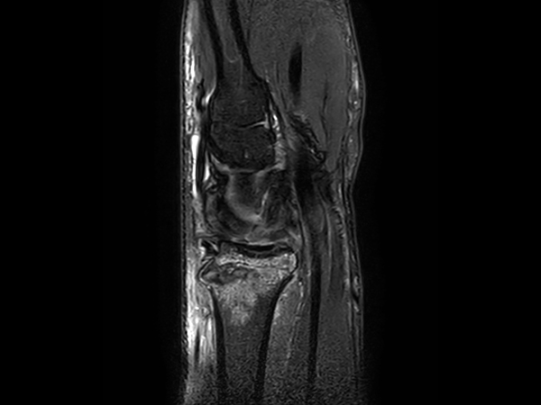 3D Sagittal PDw SPAIR