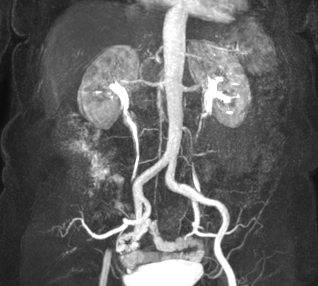 mDIXON MRA (MIP) - Abdomen