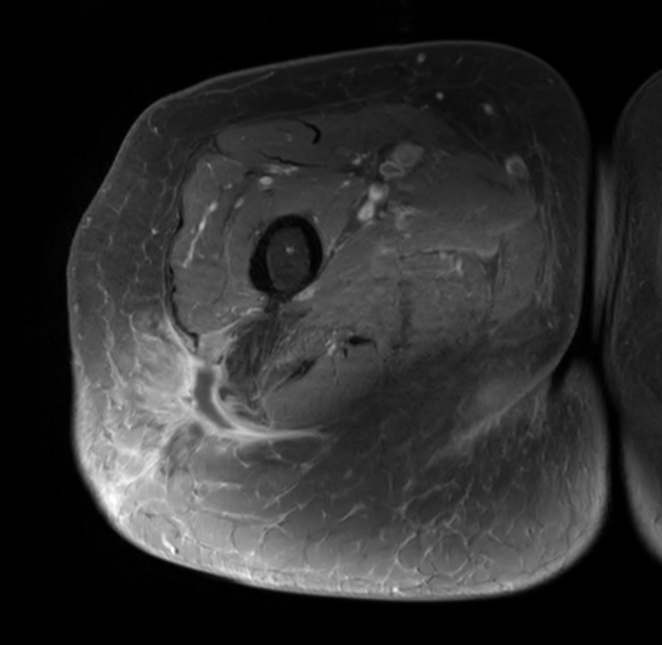 Axial T1w SPIR +gado