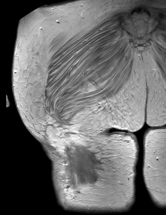 Coronal T1w TSE +gado
