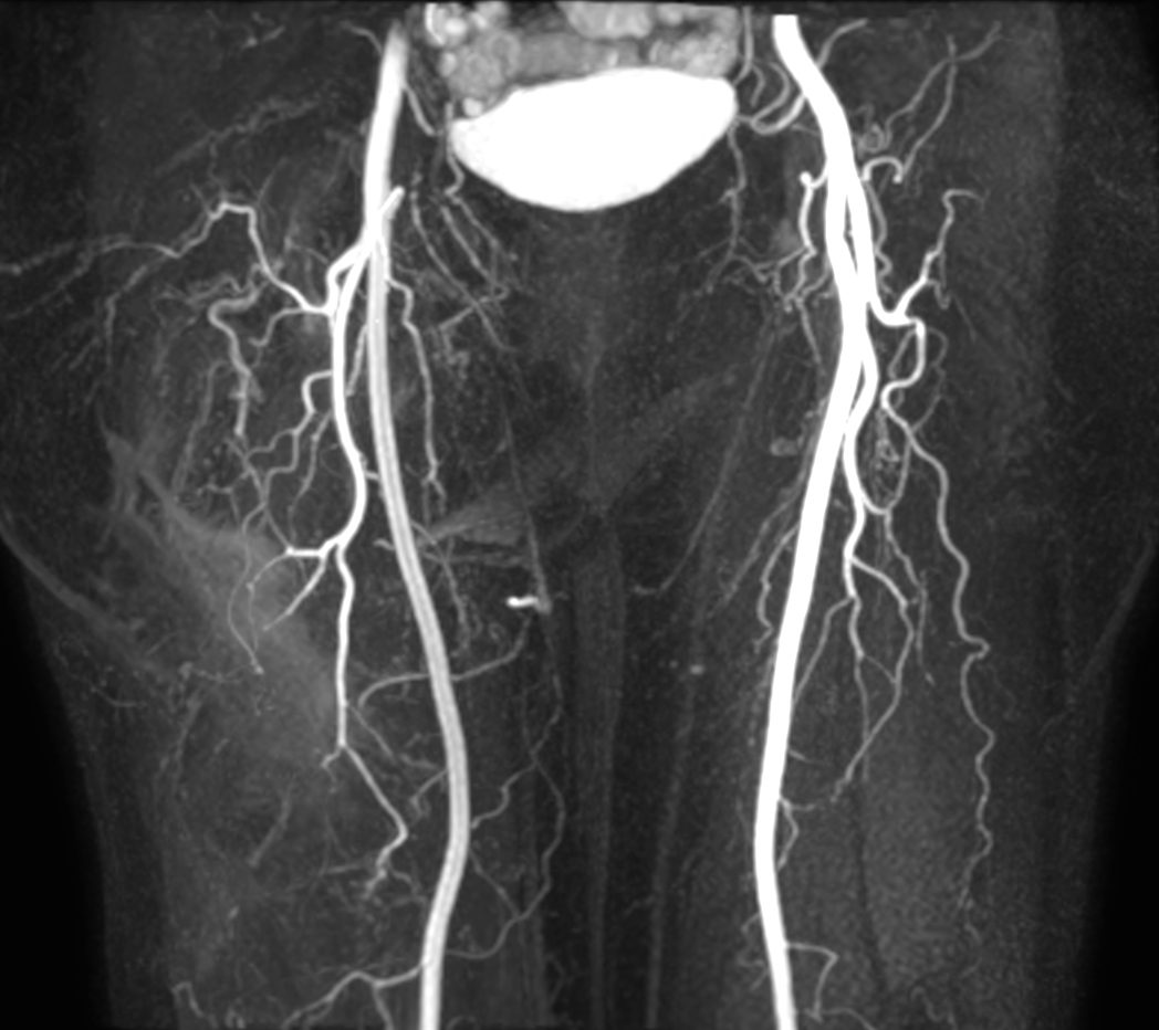 mDIXON MRA (MIP) - Upper leg