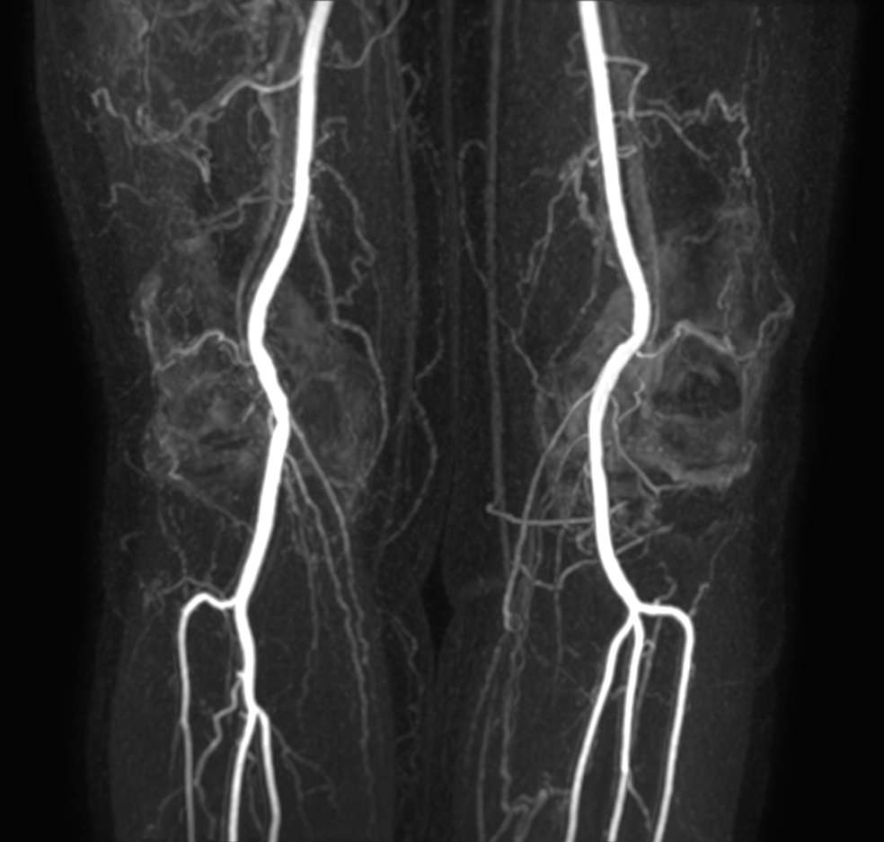 mDIXON MRA (MIP) - Lower leg