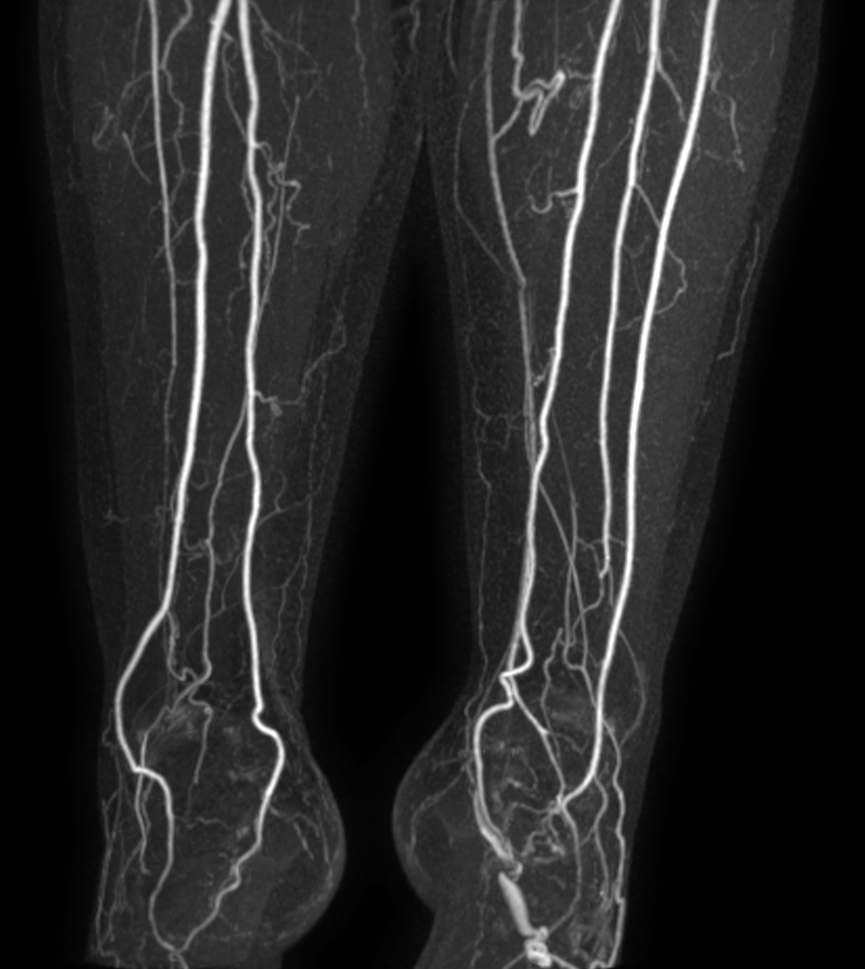 mDIXON MRA (MIP) - Feet