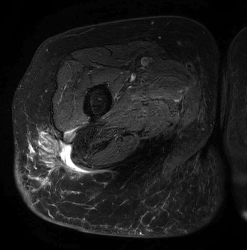 Axial T2w mDIXON XD TSE (Water only)