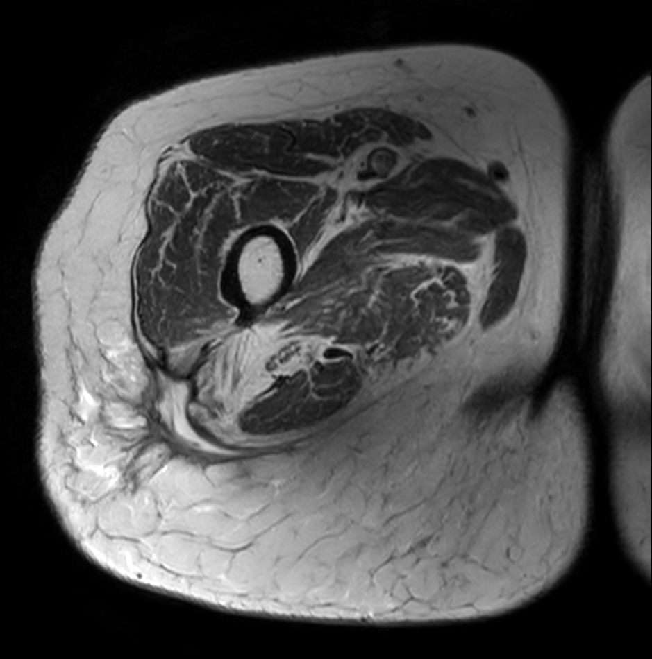 Axial T2w mDIXON XD TSE (In Phase)
