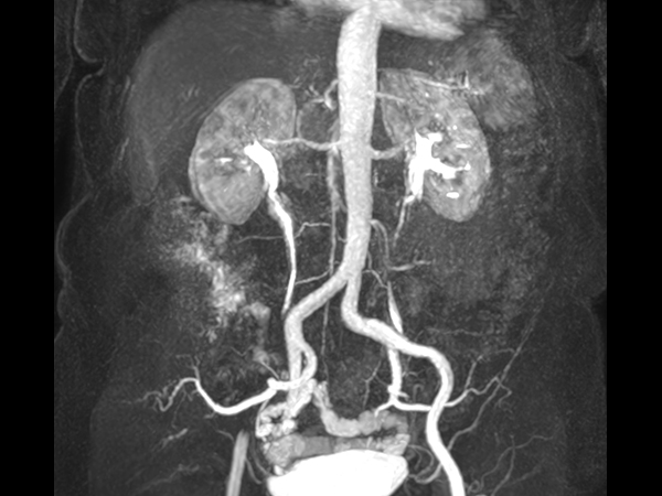 mDIXON MRA (MIP) - Abdomen