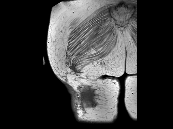 Coronal T1w TSE