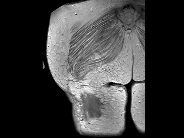 Coronal T1w TSE +gado