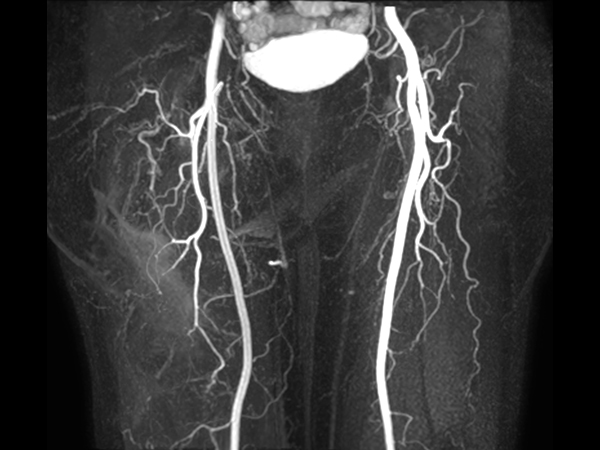 mDIXON MRA (MIP) - Upper leg