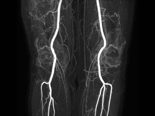 mDIXON MRA (MIP) - Lower leg