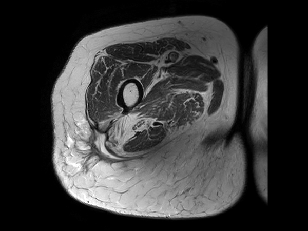 Axial T2w mDIXON XD TSE (In Phase)