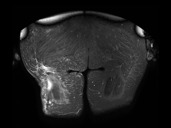 Coronal STIR