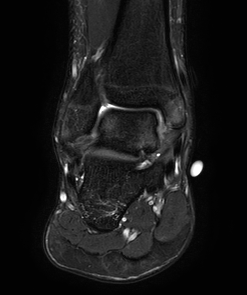 Coronal T2w TSE - mDIXON XD (Water only)